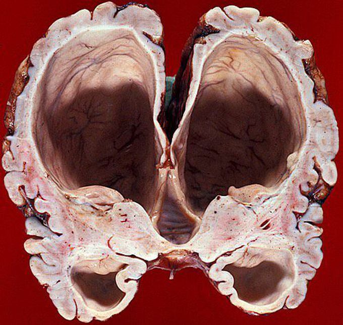 Hydrocephalus ex vacuo with some extensive white matter atrophy! 