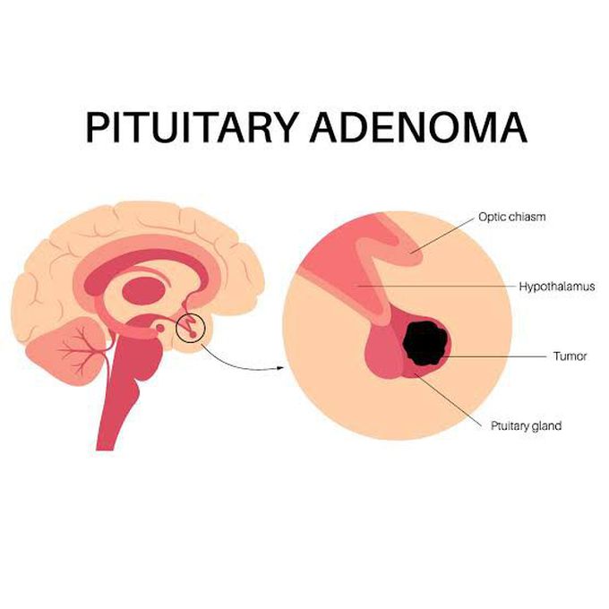 What is pituitary adenoma?