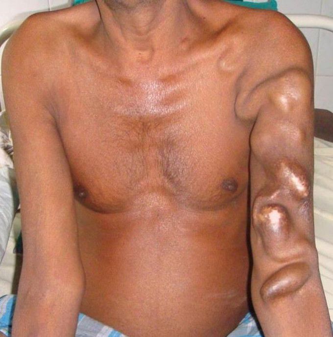 Ateriovenous fistula