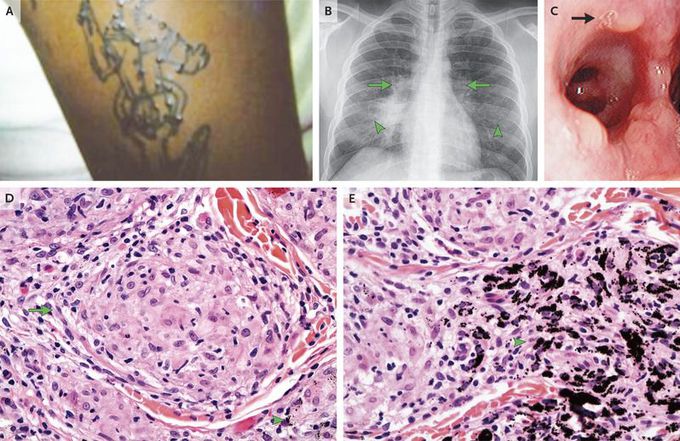 Tattoos and Sarcoidosis