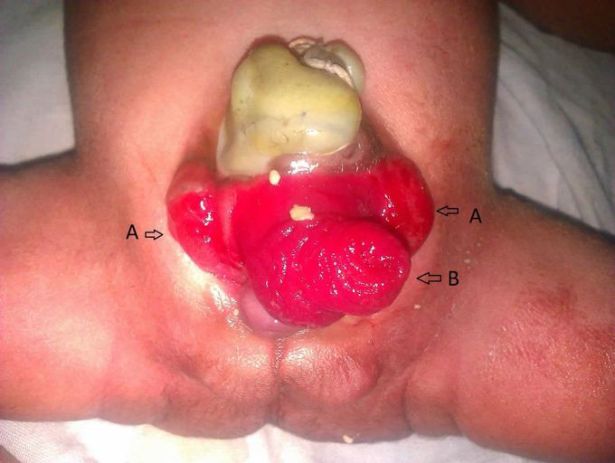 Bladder Exstrophy