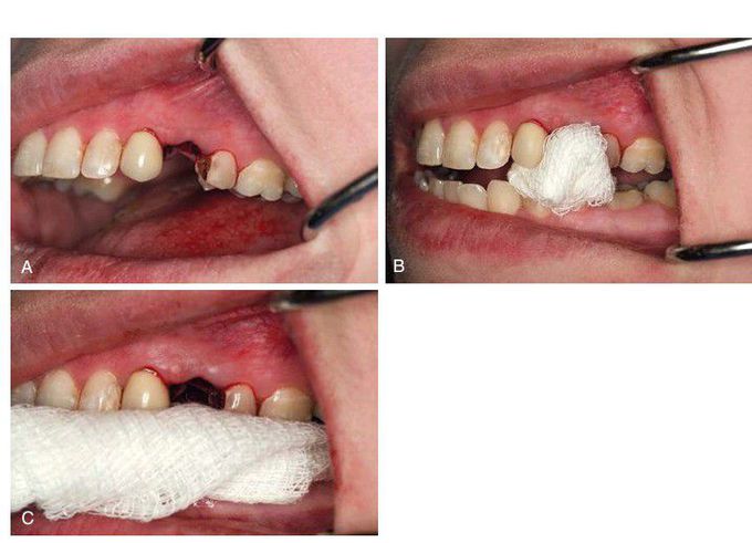 Post extraction tooth socket care