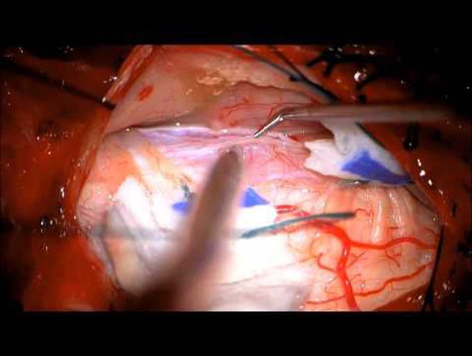 Surgical resection of subependymoma of the cervical spinal cord