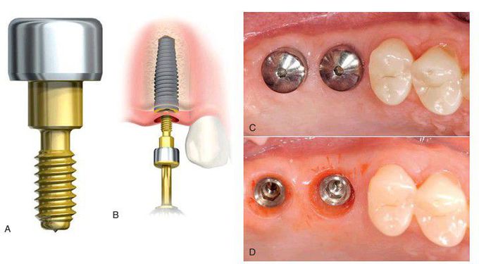 Healing abutment