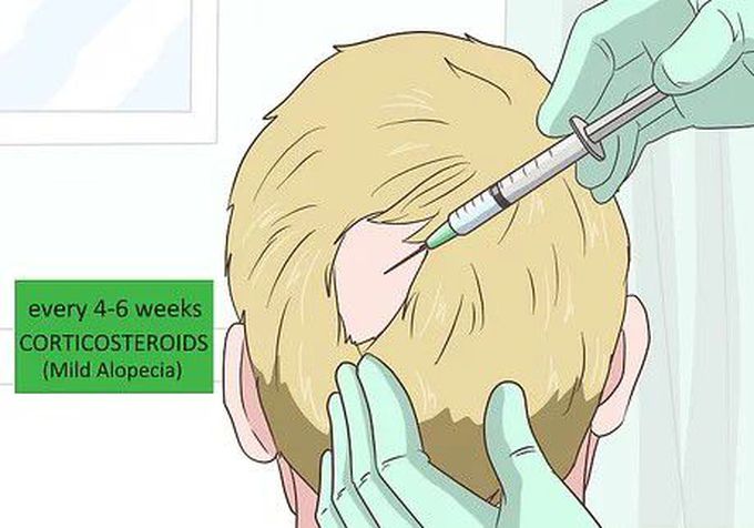 Treatment of alopecia