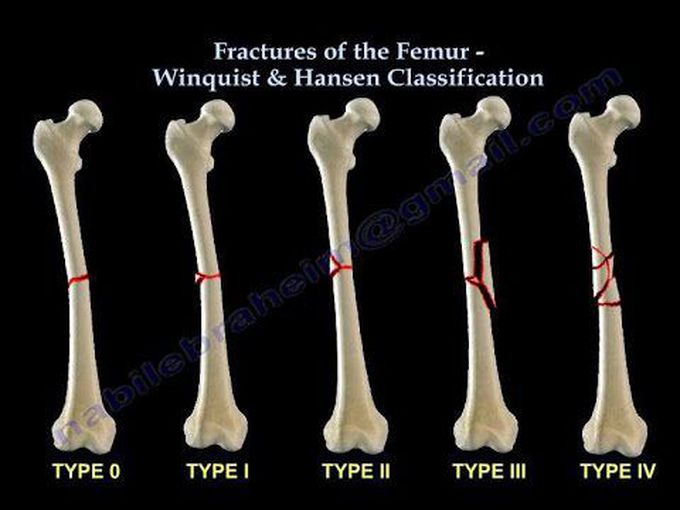 Femoral shaft fractures