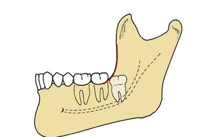 Pell and Gregory class 3 impaction