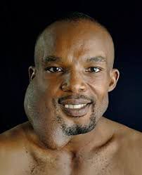 Ameloblastoma - MEDizzy