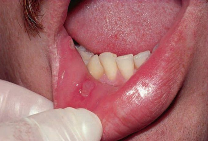 Minor aphthous ulcer of lips