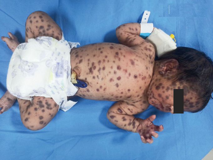 Congenital Langerhans-Cell Histiocytosis