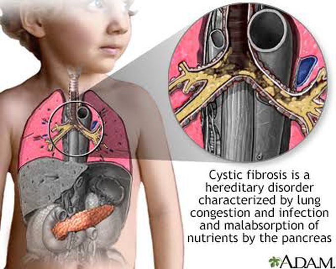 Cystic Fibrosis