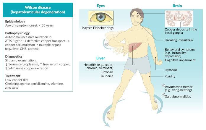 ghk-cu wilson's disease Wilson disease: MedlinePlus Genetics Wilson's disease is a rare
