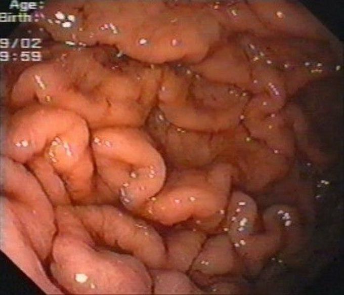 Menetrier DIsease