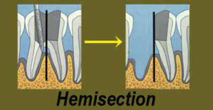 Root hemisection