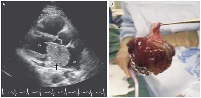 Atrial Myxoma