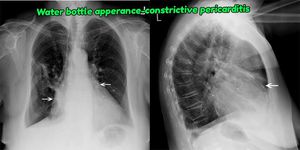 Xray Finding Of Constrictive Pericarditis - MEDizzy