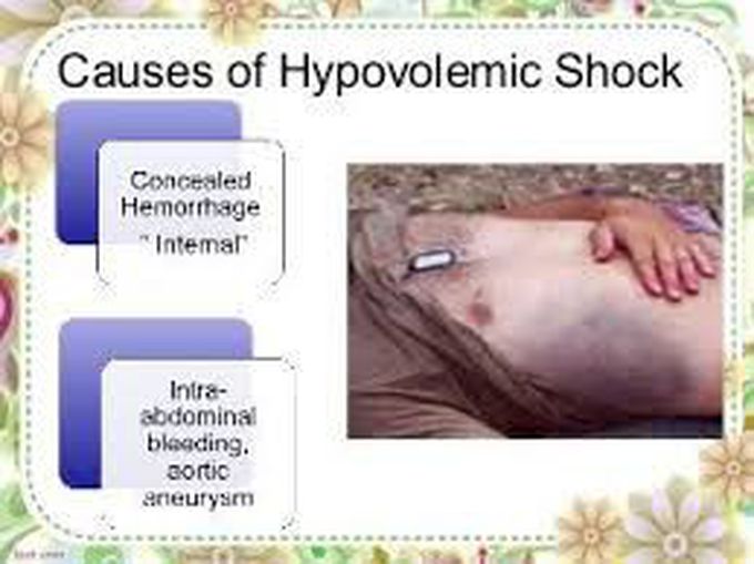 Causes of hypovolemic shock