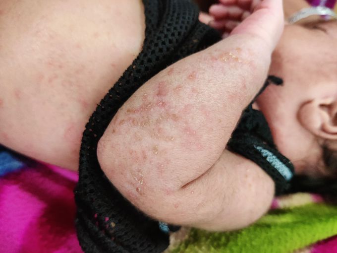 Eczema, red spots, skin rashes
