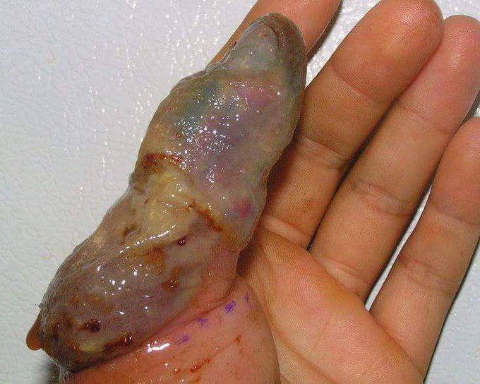It's a snake bite.....🤣😁
