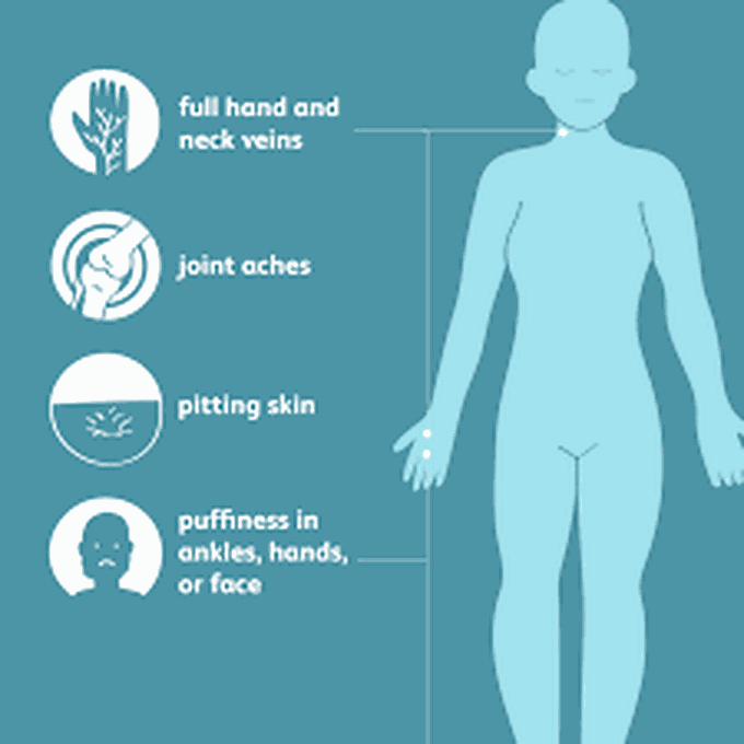 Signs and symptoms of edema