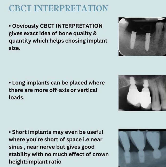 How to Choose the Correct Implant IV