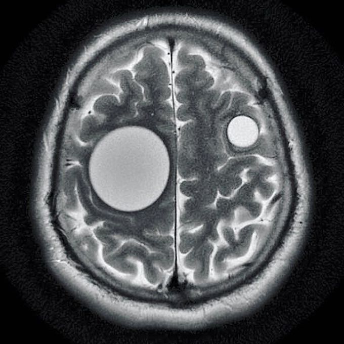 Hydatid cysts