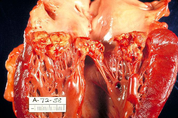 Symptoms of endocarditis