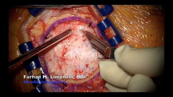 Brain Surgery: Surgical removal of a brain tumor metastatic melanoma
