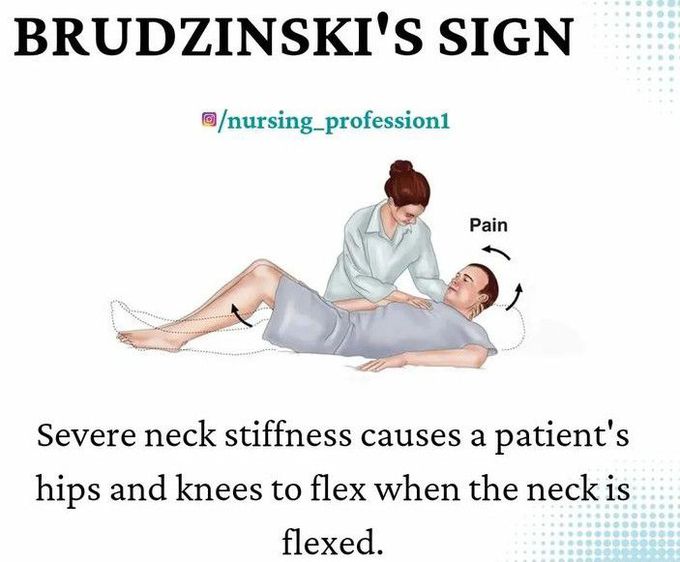 Brudzinski's Sign