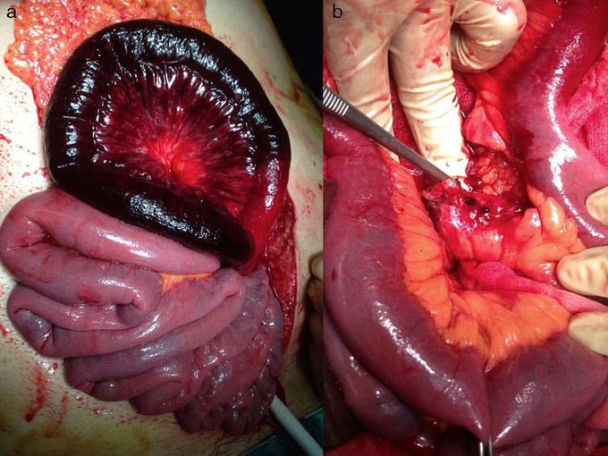 Gangrenous bowel before and after resection!! 