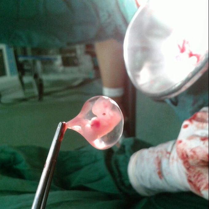 The smallest little embryo with its amniotic sac!