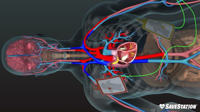 AED in Action | A 3D look inside the body