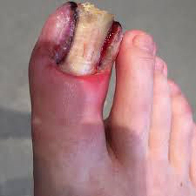 Treatment of ingrown toenail