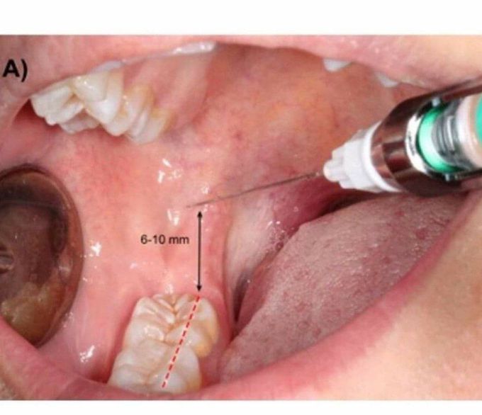 Dental anesthesia