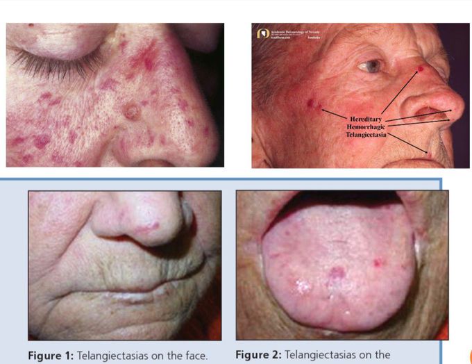 Idiopathic thrombocytopenic purpura (ITP)