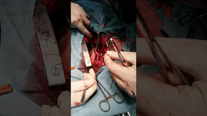 Concomitant Cardiac Surgery - VSD + AVR