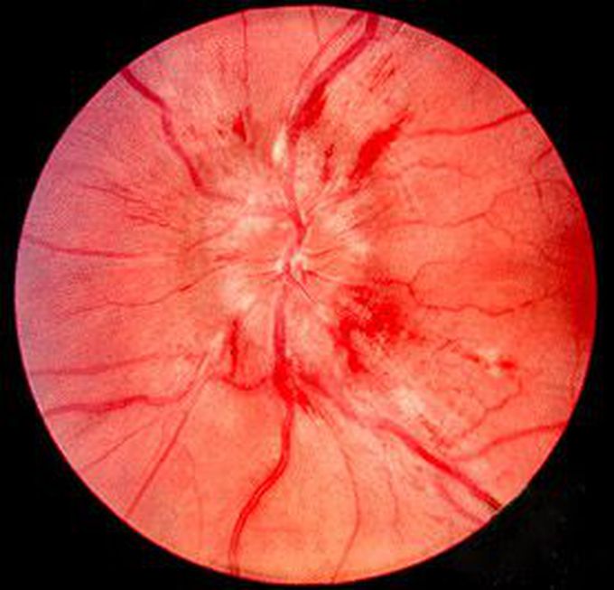 Diagnosis of papilledema