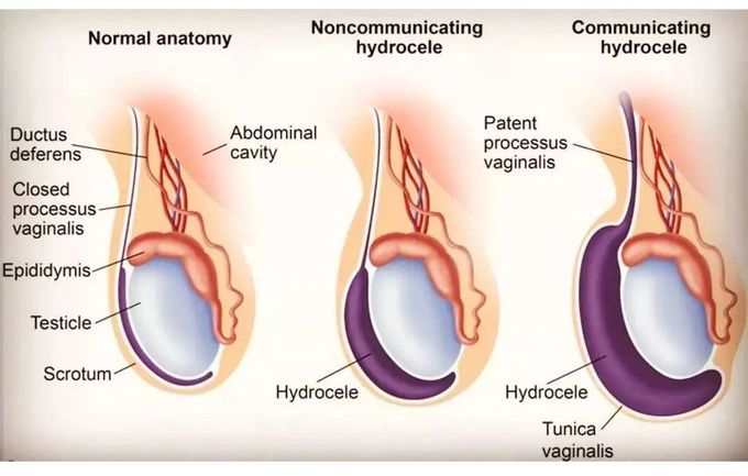 Hydrocele