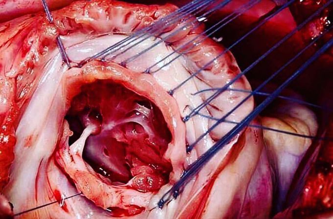 Tricuspic valve of the Heart ❤️