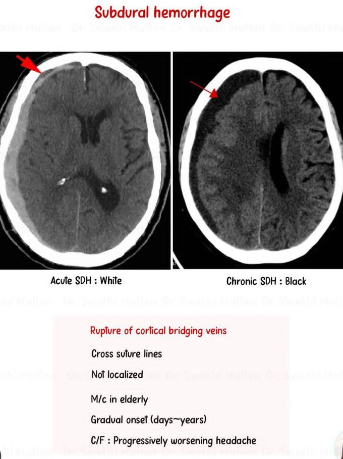 Subdural Hematoma