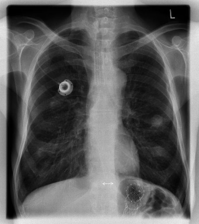 Foreign body ? Parasite ?