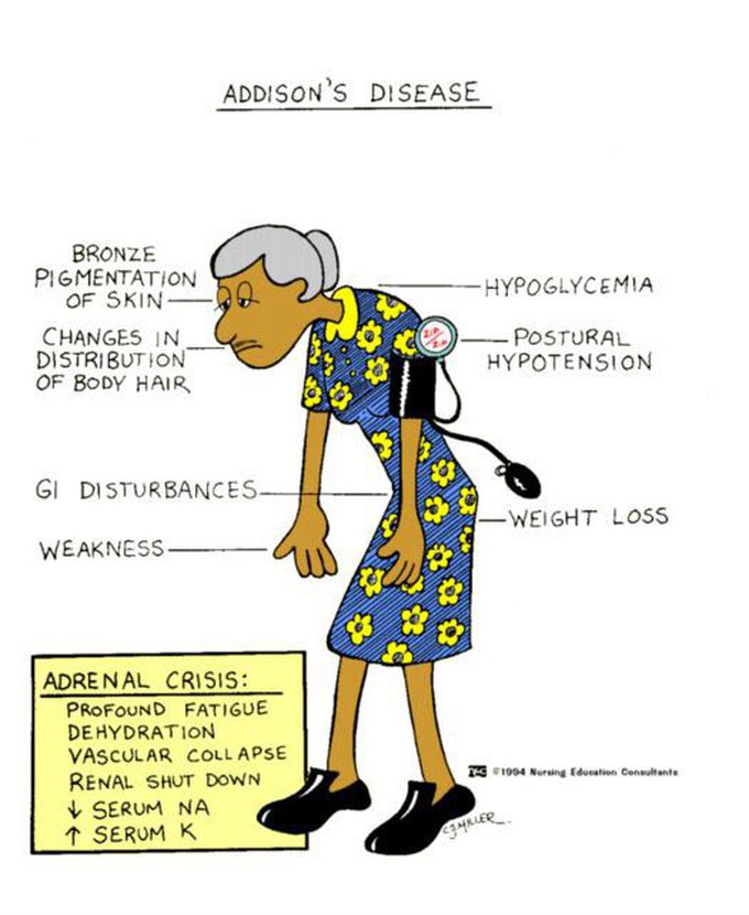 Addison s Disease MEDizzy