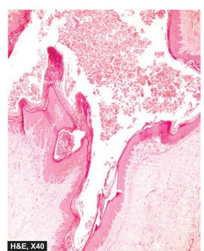 Epidermal inclusion cyst.