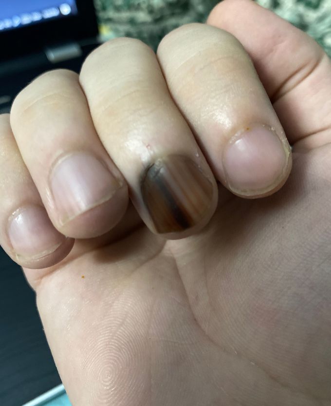 Fingernail scar