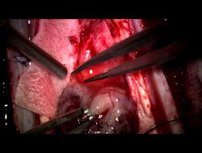 Microsurgical technique in excision of intramedullary craniocervical ependymomas
