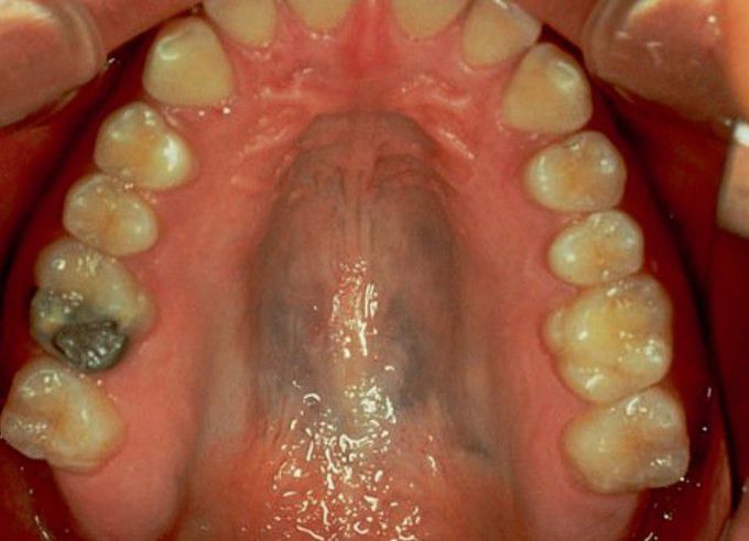 Drug induced pigmentation