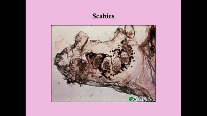 Scabies and Pubic Lice