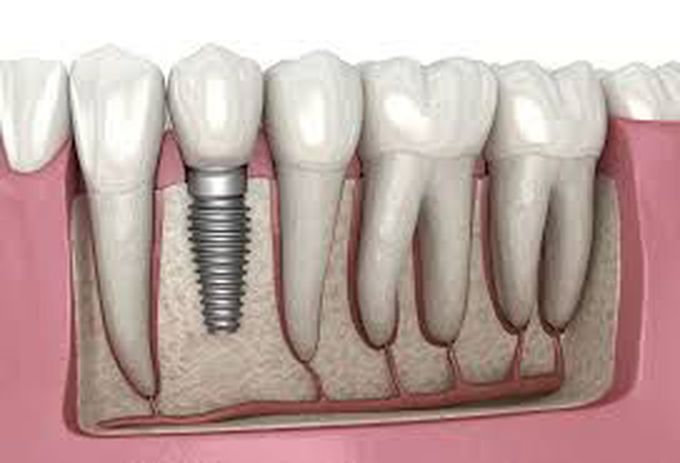 Tooth implant