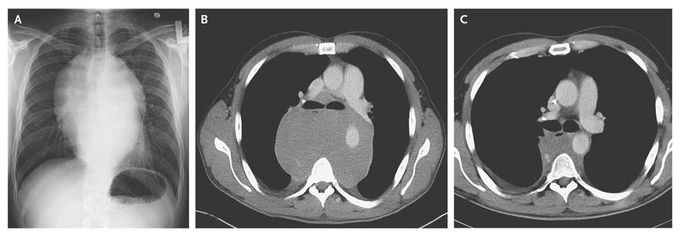 Posterior Mediastinal Mass