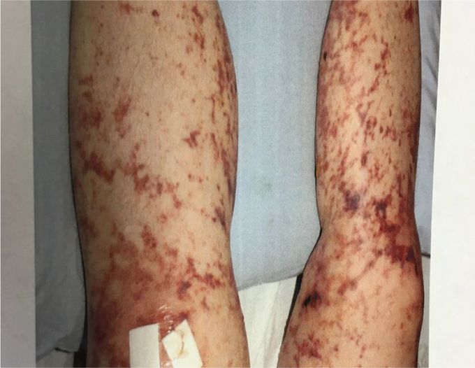 Causes of Livedo Reticularis